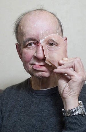 Eric Moger has a partial prosthetic face after suffering from face cancer.